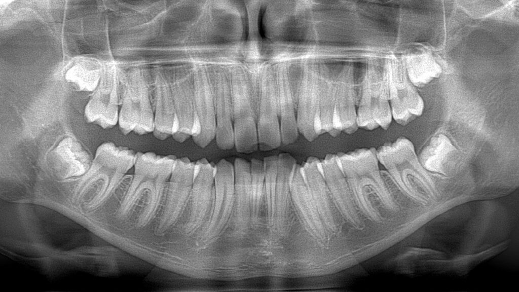 panoramica dentale