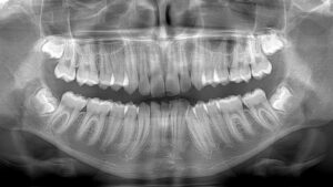 panoramica dentale